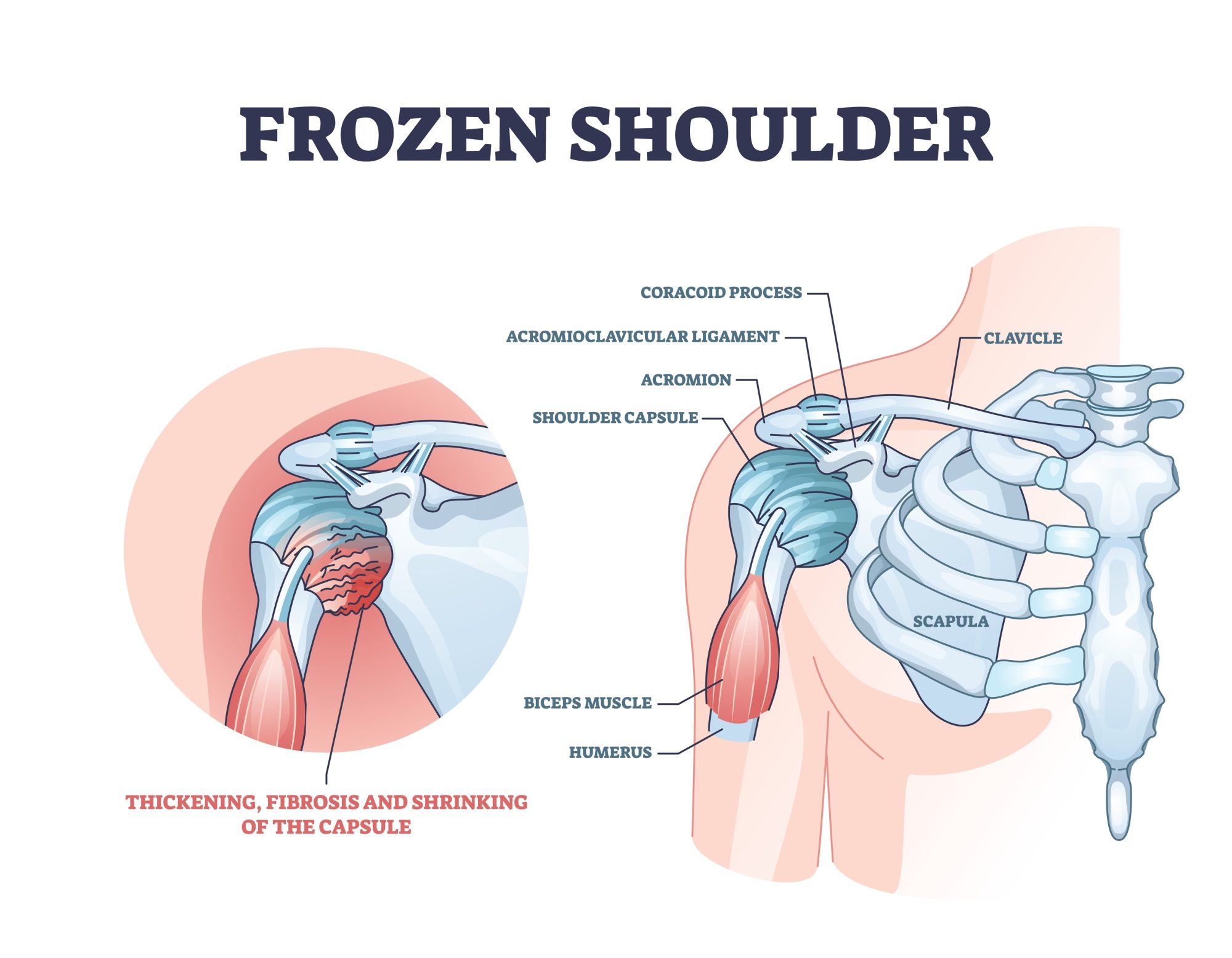Frozen Shoulder : Bahaya Sendi Bahu Kaku Dan Solusi Gerak Bebas